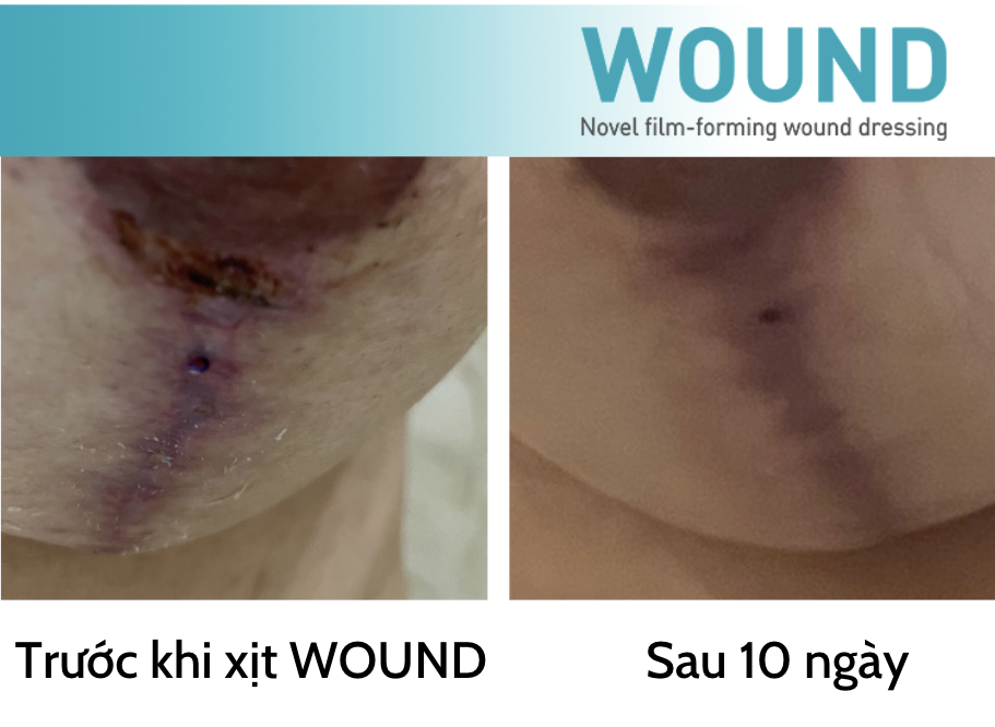 Vết thương hở: phân loại, biến chứng và giải pháp điều trị có chứng ...